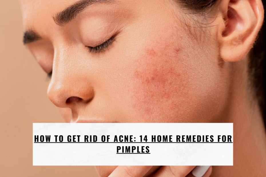 How to Get Rid of Acne: 14 Home Remedies for Pimples