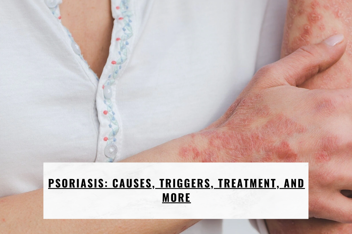Psoriasis: Causes, Triggers, Treatment, and More