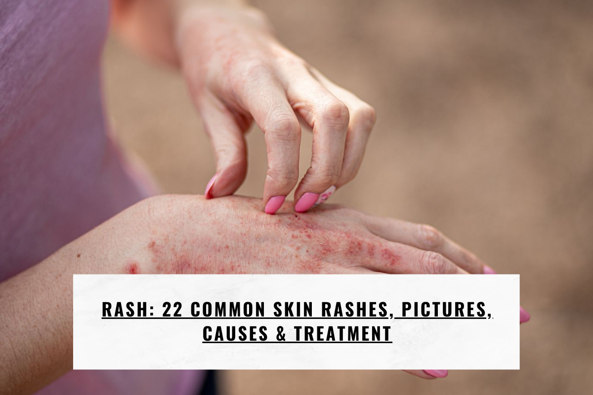 Rash: 22 Common Skin Rashes, Pictures, Causes & Treatment