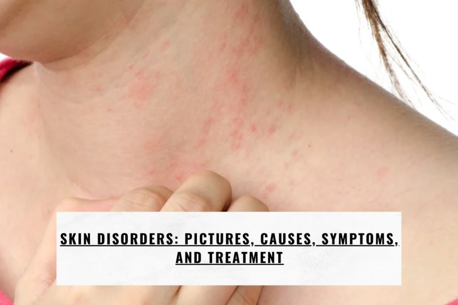 Skin Disorders: Pictures, Causes, Symptoms, and Treatment